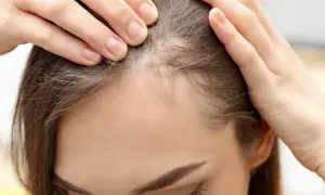 Dłonie kobiety dotykają jej głowy, sprawdzając przerzedzone włosy. Widać delikatne, cienkie baby hair przy linii czoła.